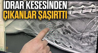 İdrar kesesinden çıkanlar şaşırttı